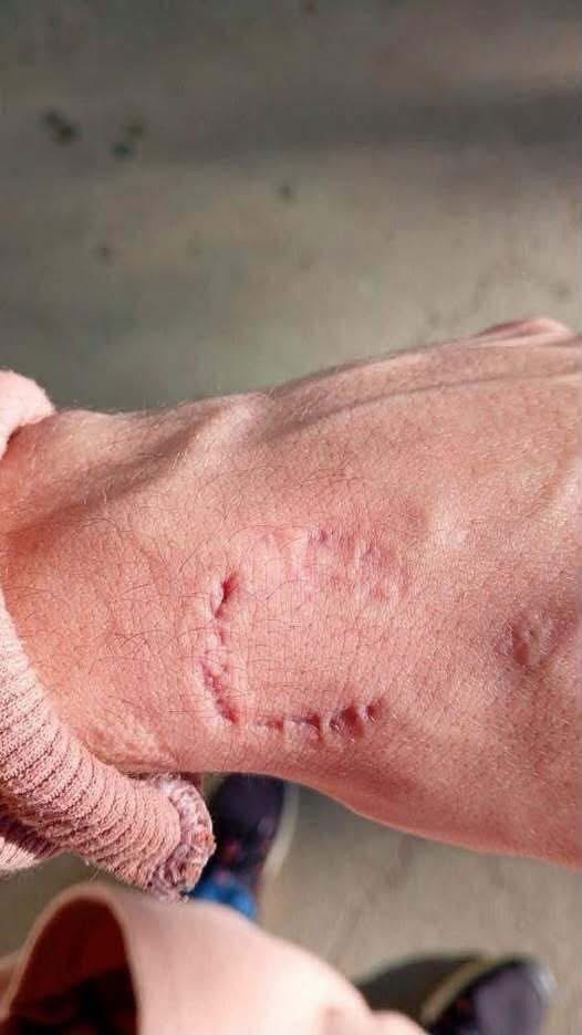 Marca en el brazo de un estudiante genera polémica por una insólita denuncia escolar