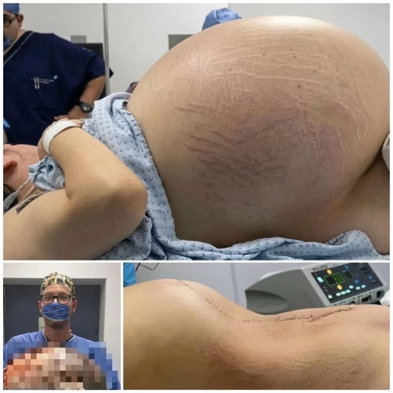 Fue al hospital por su enorme vientre y lo que ocurrió durante la cirugía sorprendió a todos