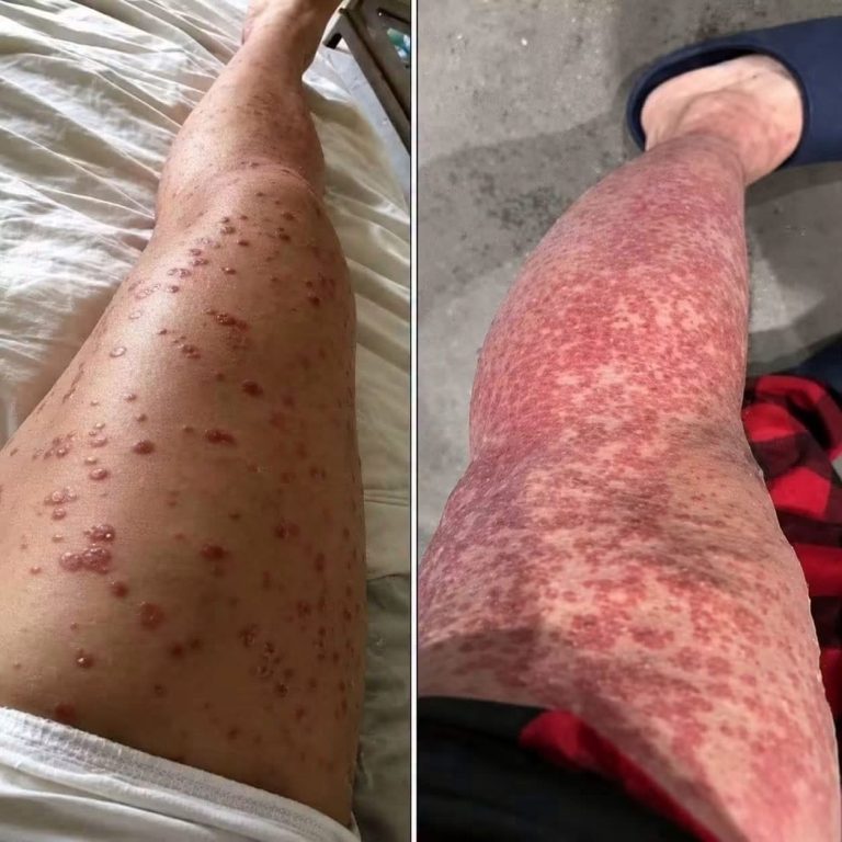 Manchas y lesiones en las piernas generan alerta: esto es lo que podría estar ocurriendo