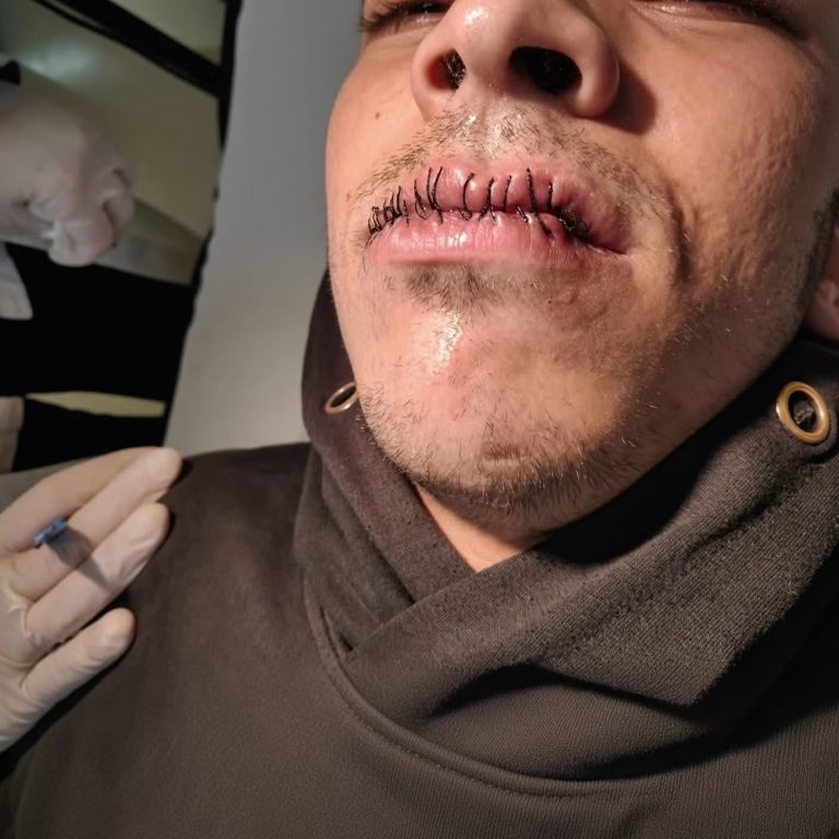 Hombre aparece con más de 20 puntos en los labios y la imagen genera impacto en redes