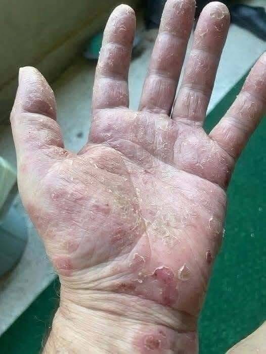 Estas señales en las manos pueden aparecer por diferentes razones… y algunas merecen atención