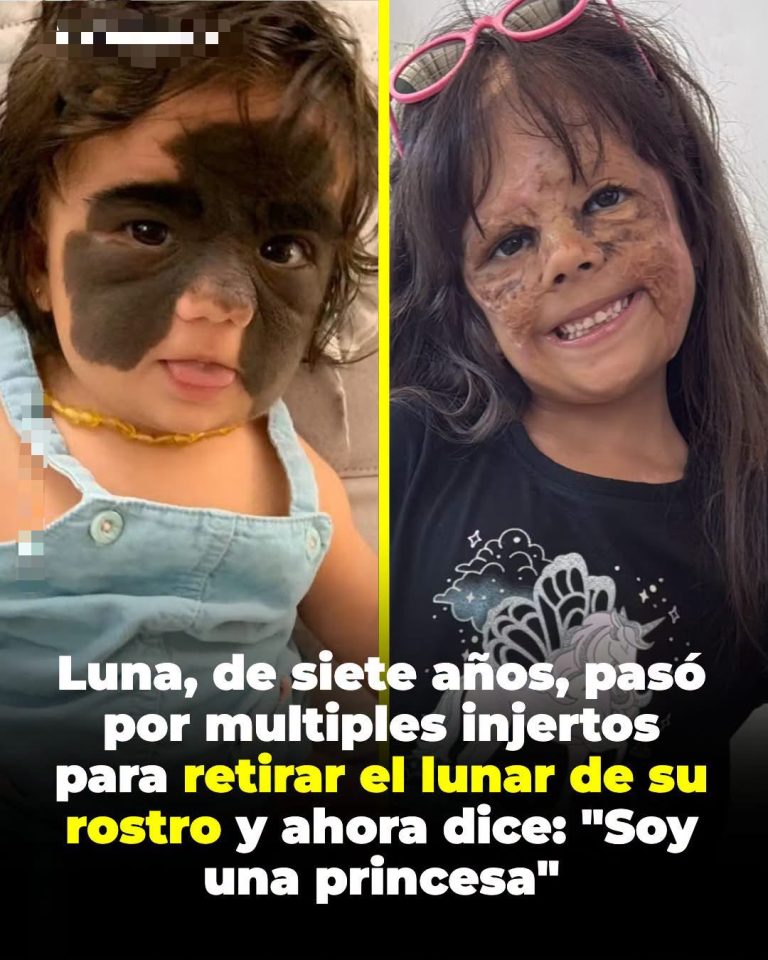 Luna Tavares-Fenner, la niña que sigue adelante tras años de tratamiento por un nevo facial